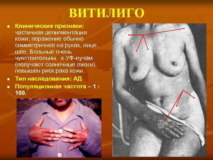 ВИТИЛИГО n n n Клинические признаки: частичная депигментация кожи; поражение обычно симметричное на руках,