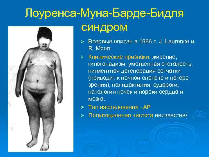 Лоуренса-Муна-Барде-Бидля синдром Ø Ø Впервые описан в 1866 г. J. Laurence и R. Moon.
