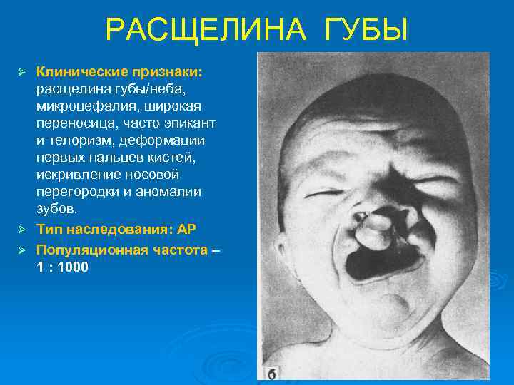 РАСЩЕЛИНА ГУБЫ Клинические признаки: расщелина губы/неба, микроцефалия, широкая переносица, часто эпикант и телоризм, деформации