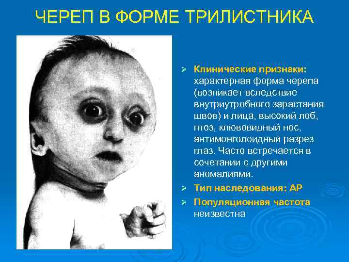 ЧЕРЕП В ФОРМЕ ТРИЛИСТНИКА Клинические признаки: характерная форма черепа (возникает вследствие внутриутробного зарастания швов)