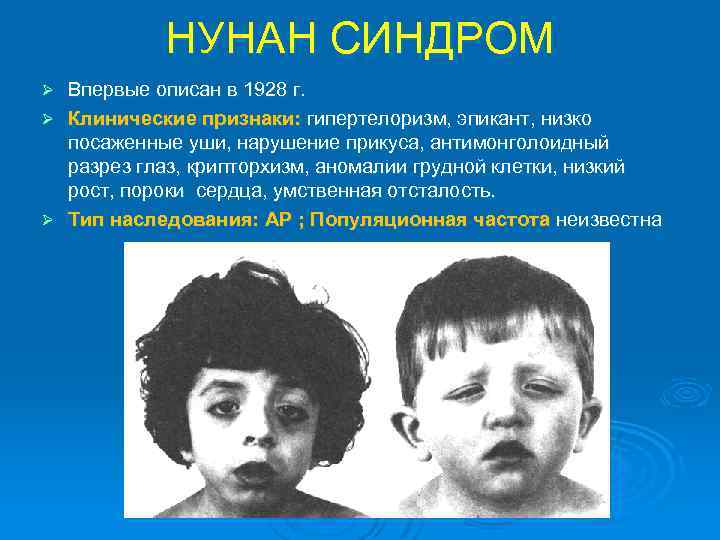 НУНАН СИНДРОМ Впервые описан в 1928 г. Ø Клинические признаки: гипертелоризм, эпикант, низко посаженные
