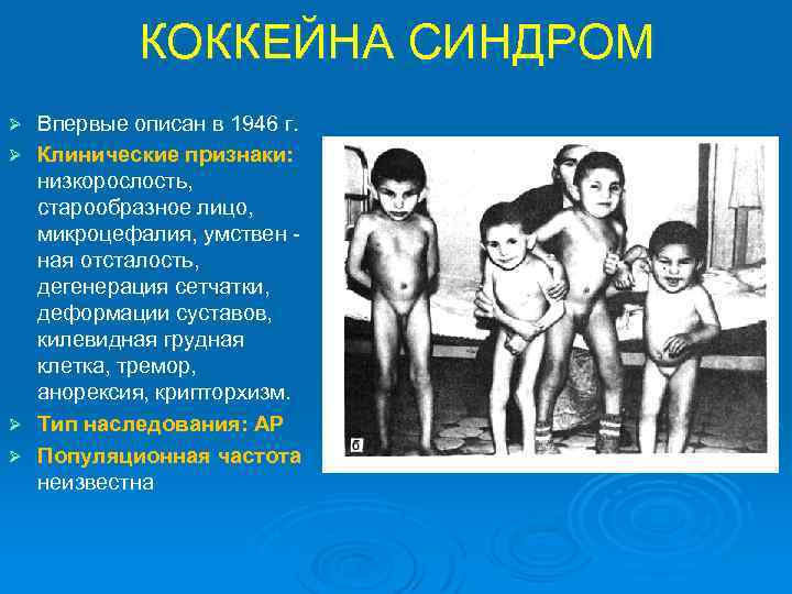 КОККЕЙНА СИНДРОМ Ø Ø Впервые описан в 1946 г. Клинические признаки: низкорослость, старообразное лицо,