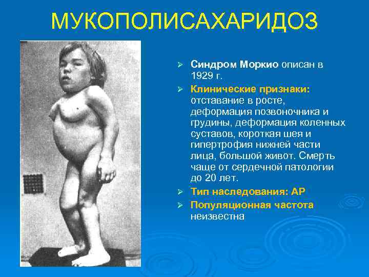 МУКОПОЛИСАХАРИДОЗ Ø Ø Синдром Моркио описан в 1929 г. Клинические признаки: отставание в росте,