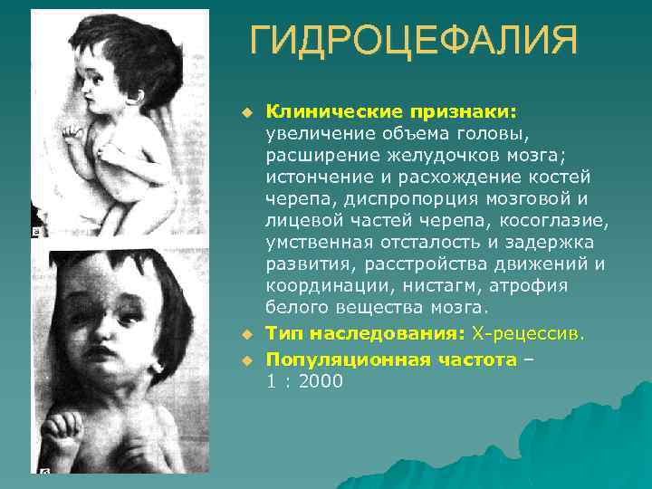 ГИДРОЦЕФАЛИЯ u u u Клинические признаки: увеличение объема головы, расширение желудочков мозга; истончение и