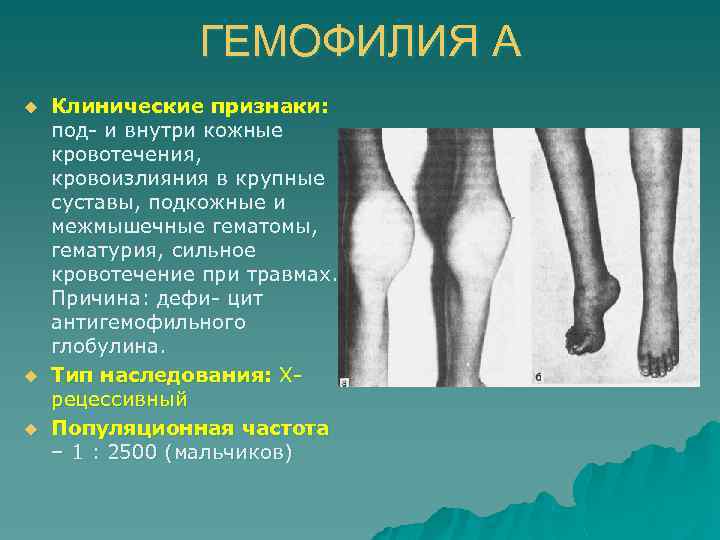 ГЕМОФИЛИЯ А u u u Клинические признаки: под- и внутри кожные кровотечения, кровоизлияния в