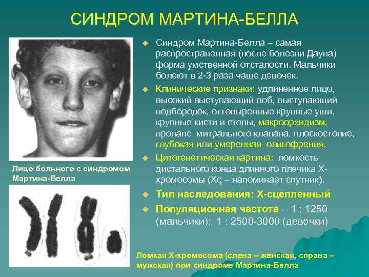 СИНДРОМ МАРТИНА-БЕЛЛА u u u Лицо больного с синдромом Мартина-Белла u u Синдром Мартина-Белла