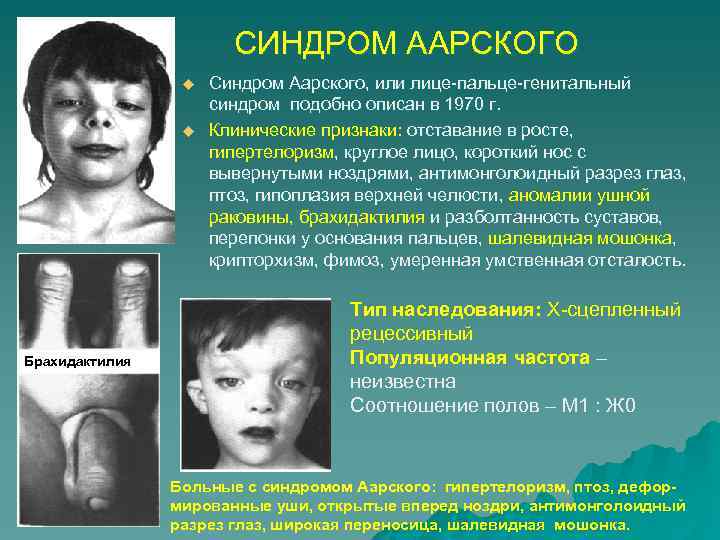 СИНДРОМ ААРСКОГО u u Брахидактилия Синдром Аарского, или лице-пальце-генитальный синдром подобно описан в 1970
