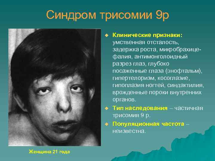Синдром трисомии 9 р u u u Женщина 21 года Клинические признаки: умственная отсталость,