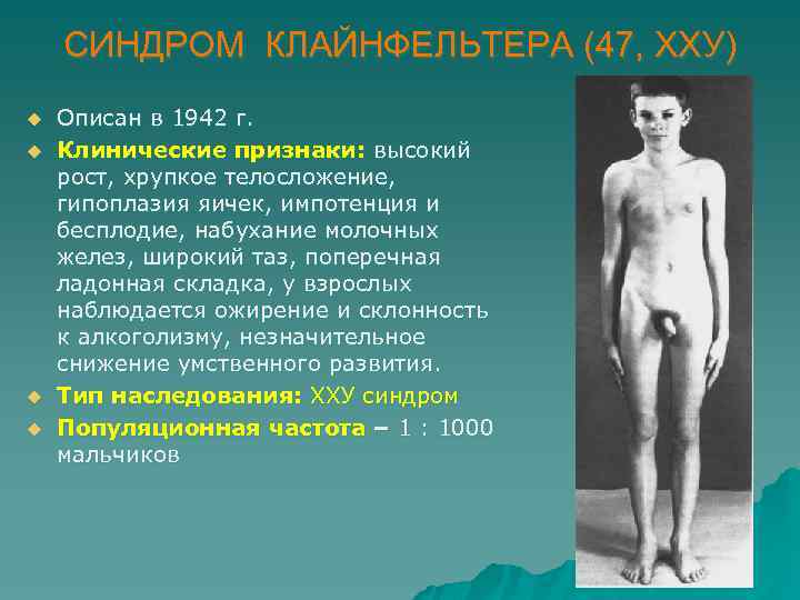 СИНДРОМ КЛАЙНФЕЛЬТЕРА (47, ХХУ) u u Описан в 1942 г. Клинические признаки: высокий рост,