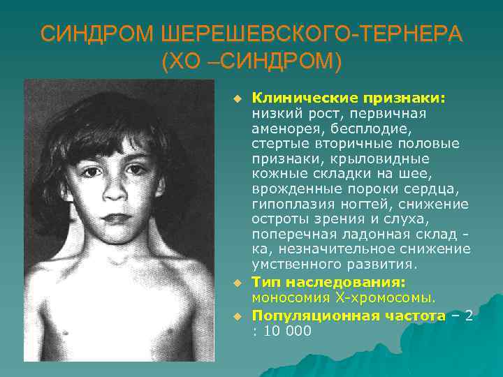 СИНДРОМ ШЕРЕШЕВСКОГО-ТЕРНЕРА (ХО –СИНДРОМ) u u u Клинические признаки: низкий рост, первичная аменорея, бесплодие,