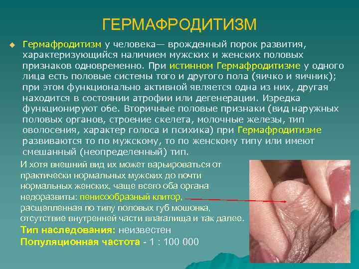 ГЕРМАФРОДИТИЗМ u Гермафродитизм у человека— врожденный порок развития, характеризующийся наличием мужских и женских половых