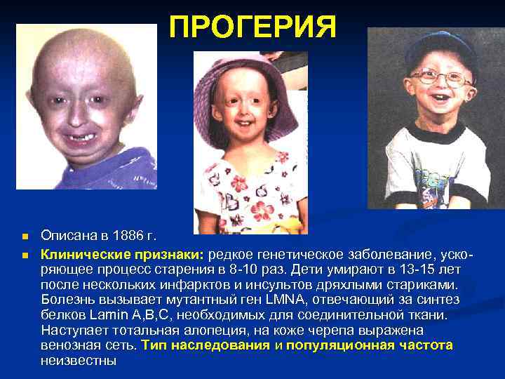 ПРОГЕРИЯ n n Описана в 1886 г. Клинические признаки: редкое генетическое заболевание, ускоряющее процесс