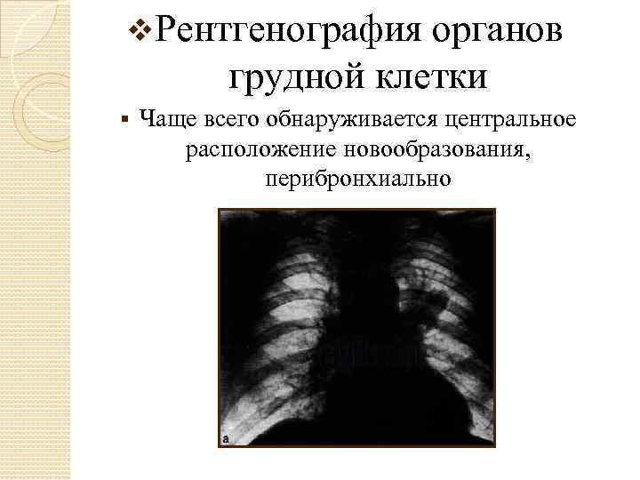 v. Рентгенография органов грудной клетки § Чаще всего обнаруживается центральное расположение новообразования, перибронхиально 