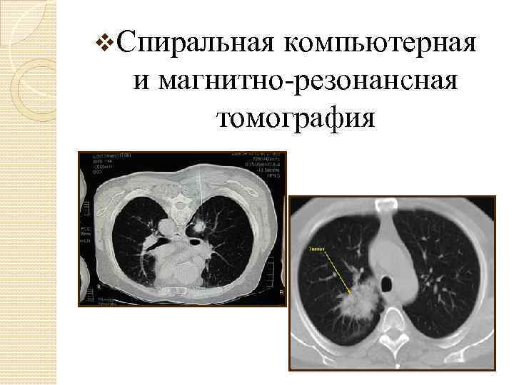 v. Спиральная компьютерная и магнитно-резонансная томография 