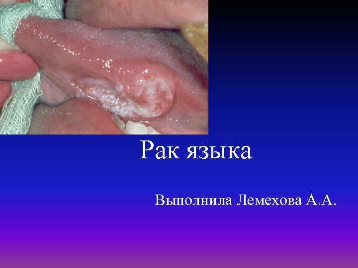 Рак языка Выполнила Лемехова А. А. 