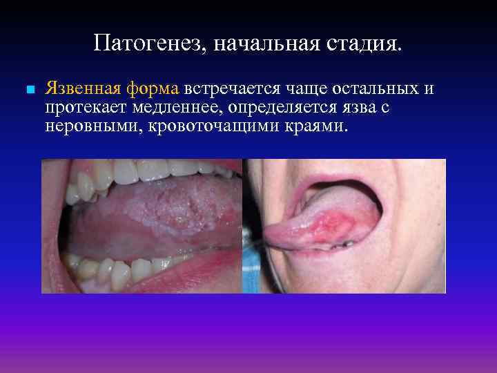 Патогенез, начальная стадия. n Язвенная форма встречается чаще остальных и протекает медленнее, определяется язва