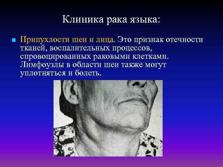 Клиника рака языка: n Припухлости шеи и лица. Это признак отечности тканей, воспалительных процессов,
