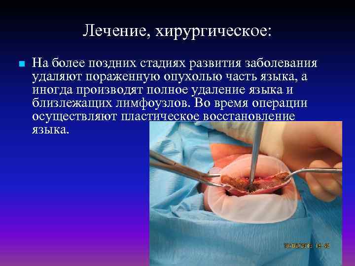 Лечение, хирургическое: n На более поздних стадиях развития заболевания удаляют пораженную опухолью часть языка,