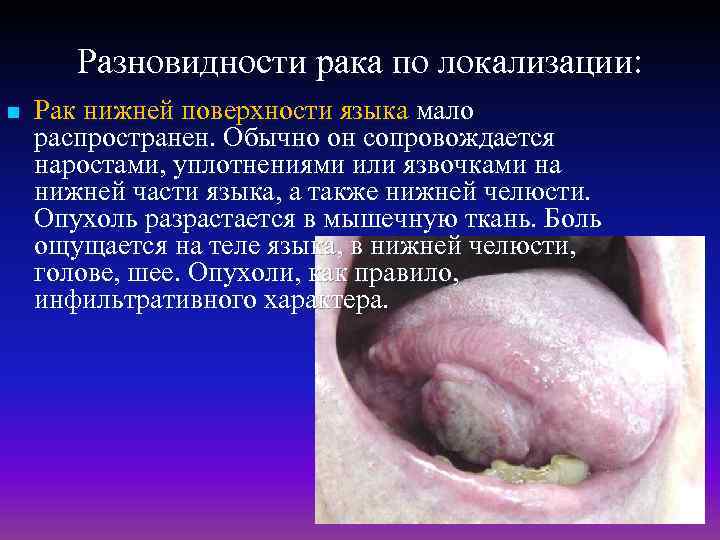 Разновидности рака по локализации: n Рак нижней поверхности языка мало распространен. Обычно он сопровождается