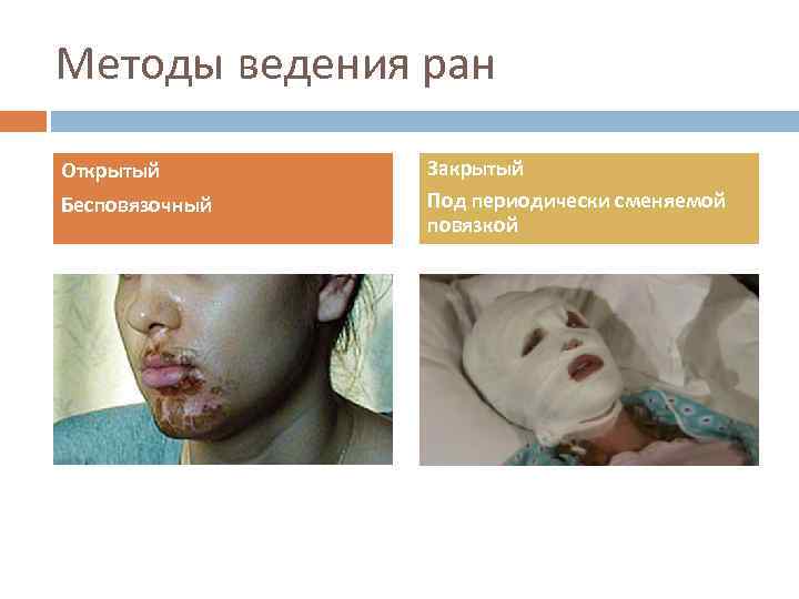 Методы ведения ран Открытый Бесповязочный Закрытый Под периодически сменяемой повязкой 
