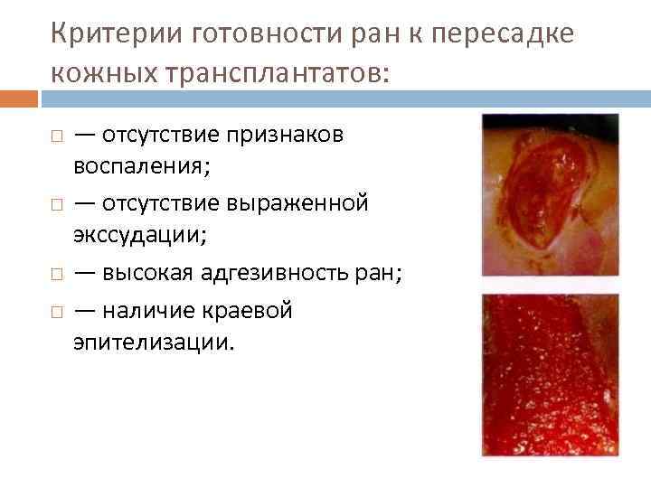 Критерии готовности ран к пересадке кожных трансплантатов: — отсутствие признаков воспаления; — отсутствие выраженной