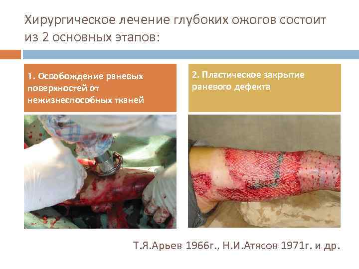 Хирургическое лечение глубоких ожогов состоит из 2 основных этапов: 1. Освобождение раневых поверхностей от