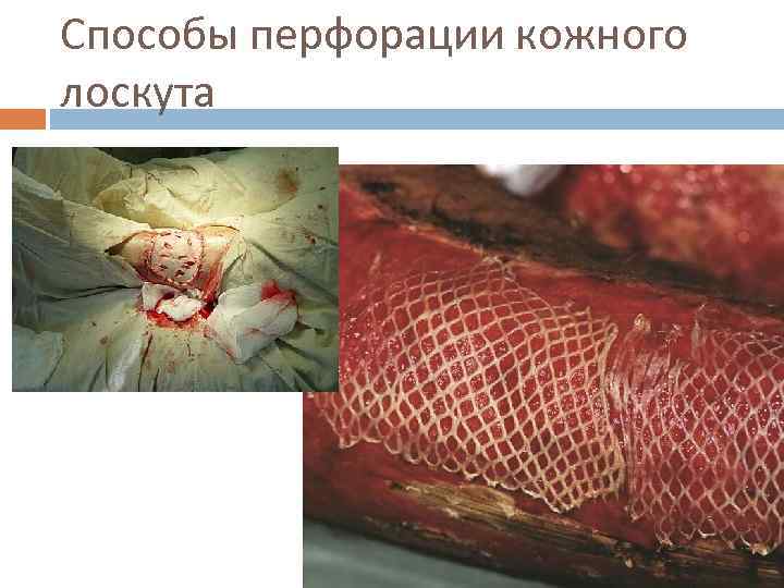 Способы перфорации кожного лоскута 