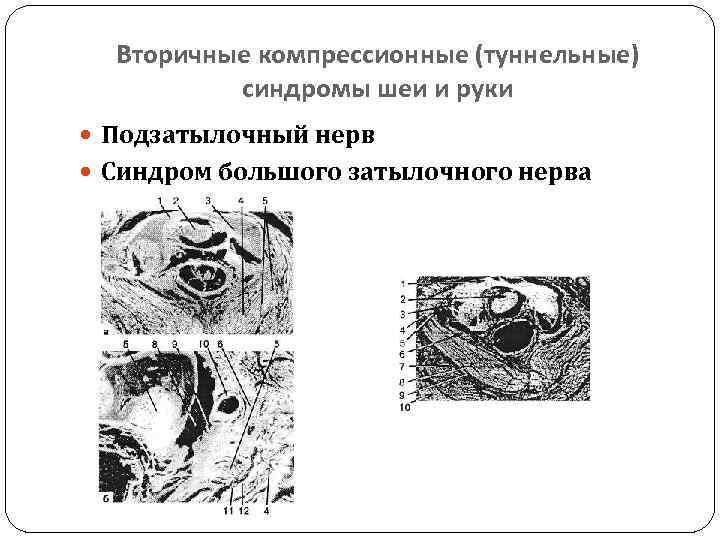 Вторичные компрессионные (туннельные) синдромы шеи и руки Подзатылочный нерв Синдром большого затылочного нерва 