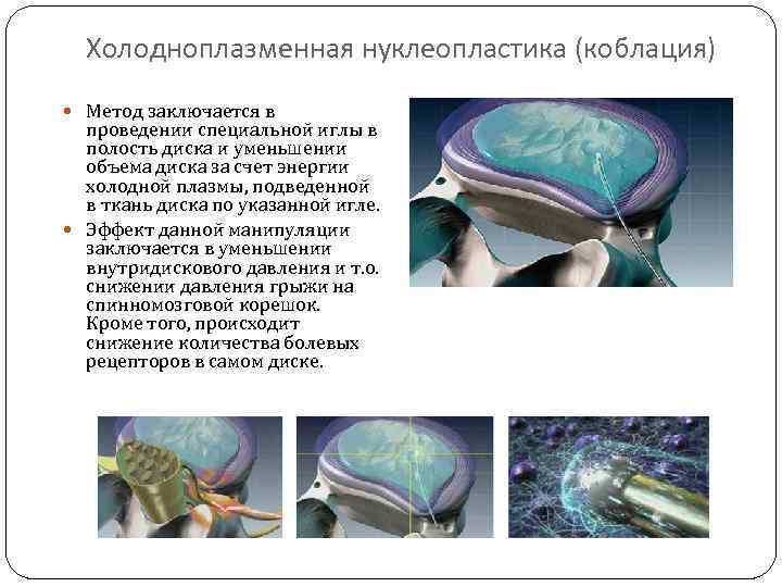 Холодноплазменная нуклеопластика (коблация) Метод заключается в проведении специальной иглы в полость диска и уменьшении