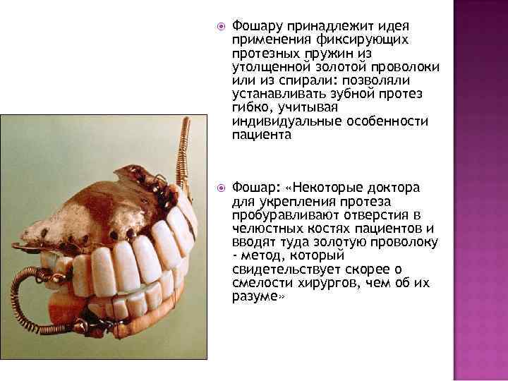 Фошару принадлежит идея применения фиксирующих протезных пружин из утолщенной золотой проволоки или из