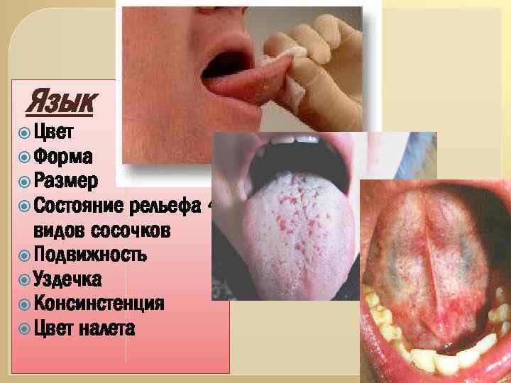 Язык Цвет Форма Размер рельефа 4 видов сосочков Подвижность Уздечка Консинстенция Цвет налета Состояние