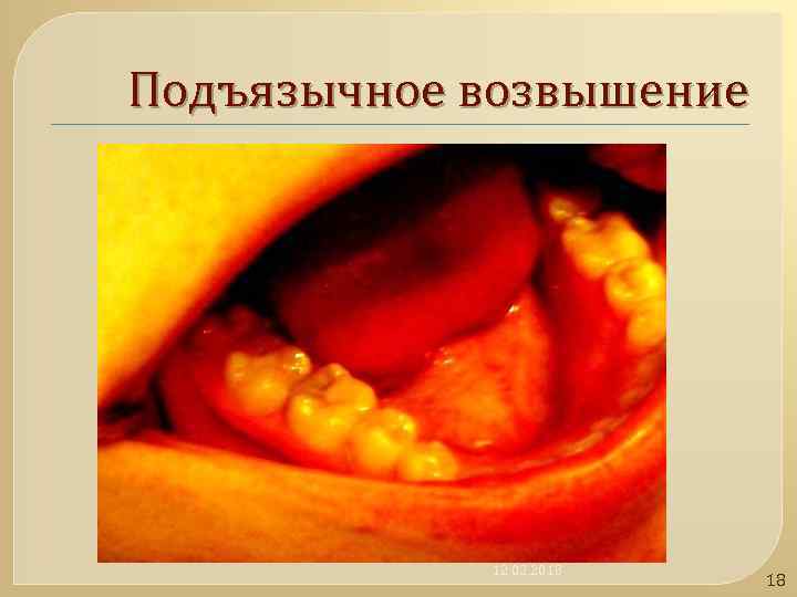 Подъязычное возвышение 12. 02. 2018 18 