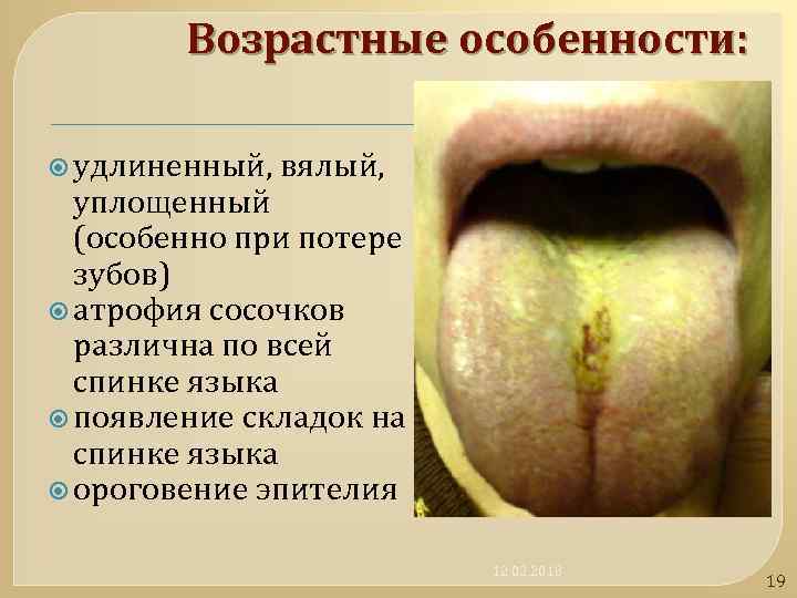 Возрастные особенности: удлиненный, вялый, уплощенный (особенно при потере зубов) атрофия сосочков различна по всей
