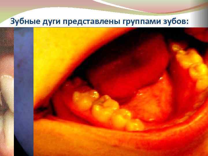 Зубные дуги представлены группами зубов: 