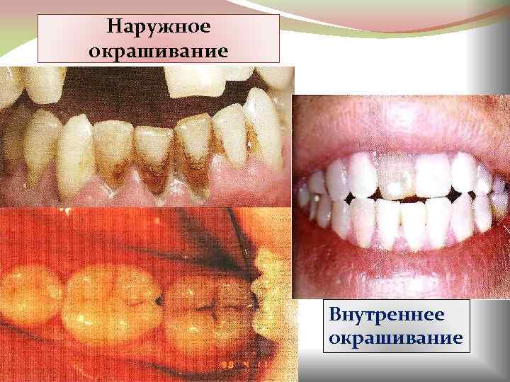 Наружное окрашивание Внутреннее окрашивание 