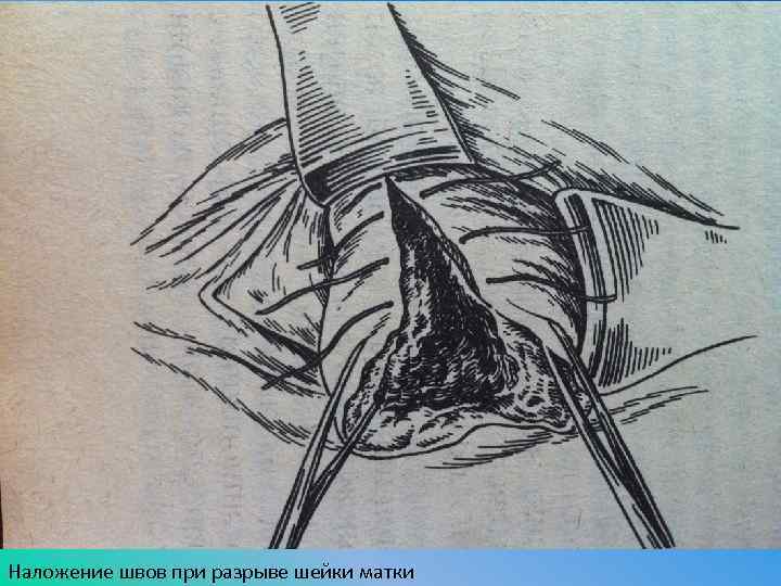 Наложение швов при разрыве шейки матки 