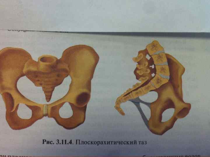 Узкий таз фото