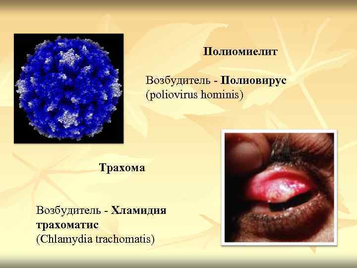 Полиомиелит Возбудитель - Полиовирус (poliovirus hominis) Трахома Возбудитель - Хламидия трахоматис (Chlamydia trachomatis) 