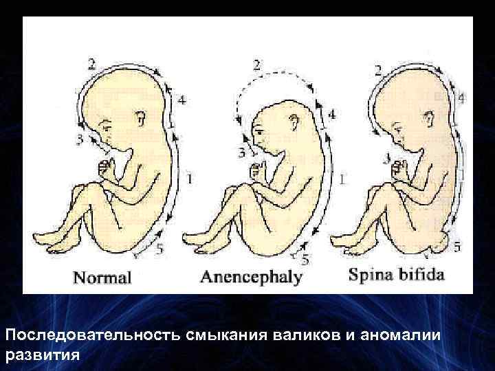 Последовательность смыкания валиков и аномалии развития 