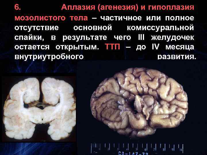 6. Аплазия (агенезия) и гипоплазия мозолистого тела – частичное или полное отсутствие основной комиссуральной