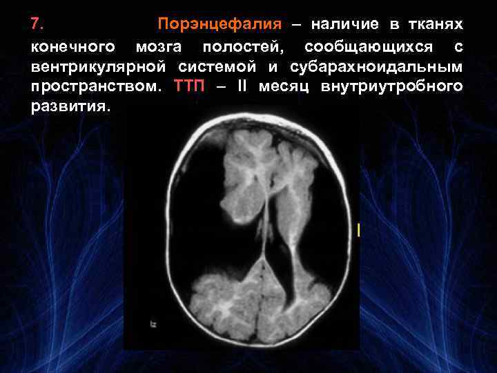 7. Порэнцефалия – наличие в тканях конечного мозга полостей, сообщающихся с вентрикулярной системой и