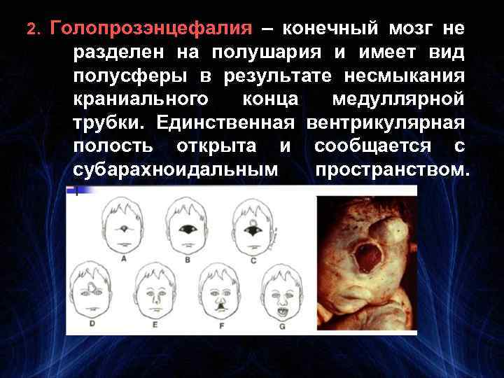 2. Голопрозэнцефалия – конечный мозг не разделен на полушария и имеет вид полусферы в