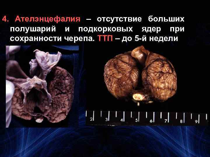 4. Ателэнцефалия – отсутствие больших полушарий и подкорковых ядер при сохранности черепа. ТТП –