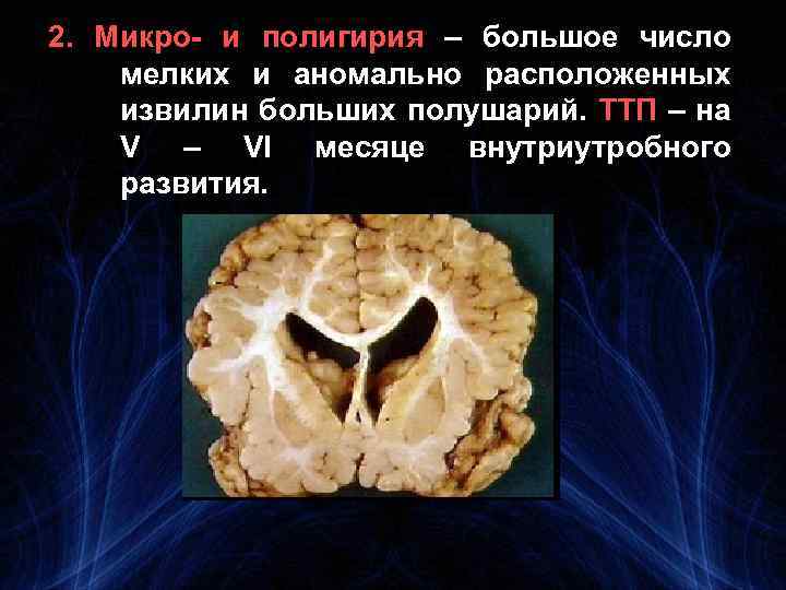 2. Микро- и полигирия – большое число мелких и аномально расположенных извилин больших полушарий.