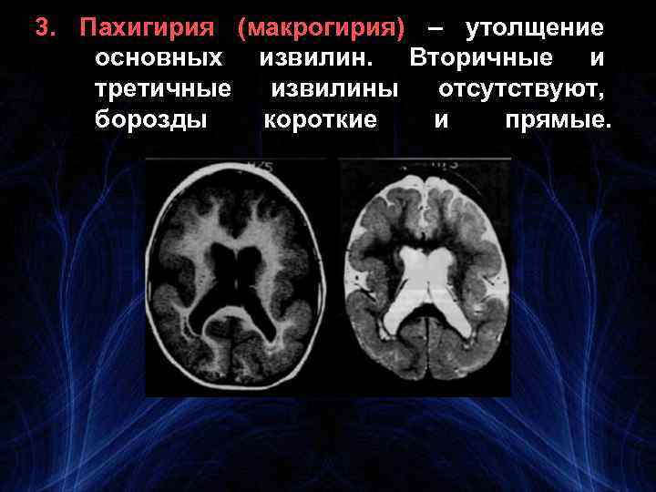 3. Пахигирия (макрогирия) – утолщение основных извилин. Вторичные и третичные извилины отсутствуют, борозды короткие