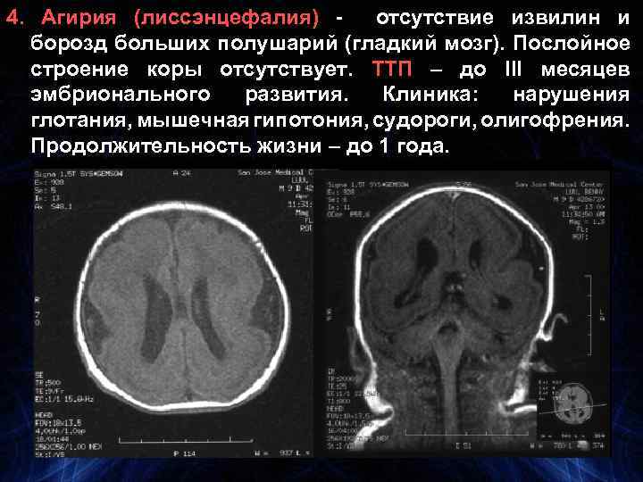 4. Агирия (лиссэнцефалия) отсутствие извилин и борозд больших полушарий (гладкий мозг). Послойное строение коры