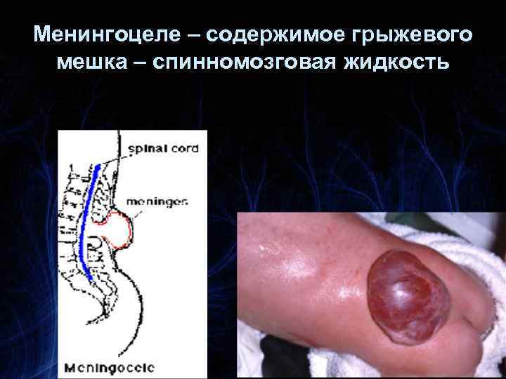 Менингоцеле – содержимое грыжевого мешка – спинномозговая жидкость 