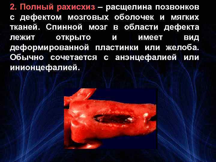 2. Полный рахисхиз – расщелина позвонков с дефектом мозговых оболочек и мягких тканей. Спинной