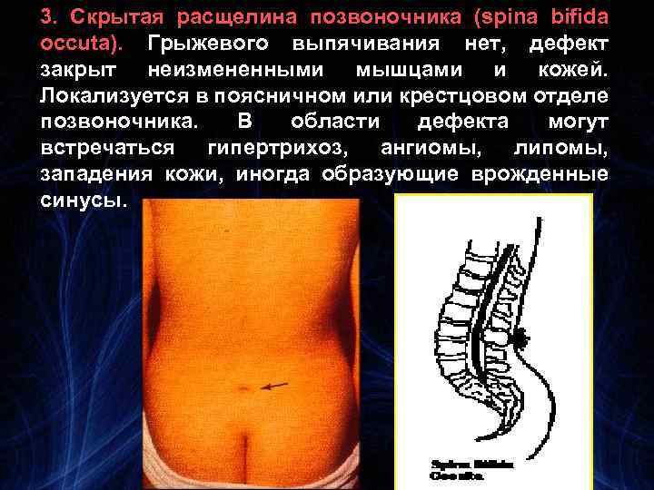 3. Скрытая расщелина позвоночника (spina bifida occuta). Грыжевого выпячивания нет, дефект закрыт неизмененными мышцами