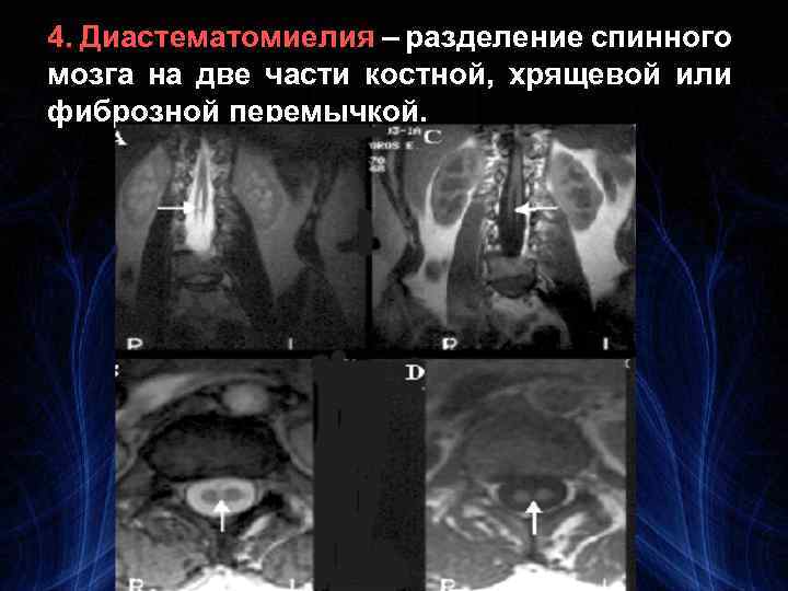 4. Диастематомиелия – разделение спинного мозга на две части костной, хрящевой или фиброзной перемычкой.